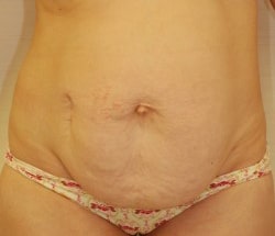 Abdominoplasty Case 1