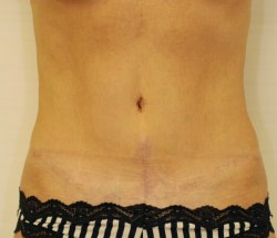 Abdominoplasty Case 4