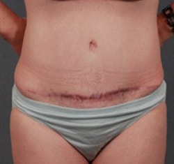 Abdominoplasty Case 7