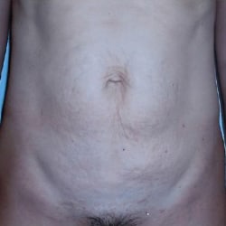 Abdominoplasty Case 9