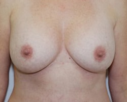 Breast Augmentation Case 2