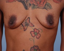 Breast Augmentation Case 3
