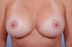 Breast Augmentation Case 4
