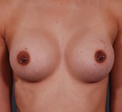 Breast Augmentation Case 6