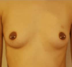 Breast Augmentation Case 6