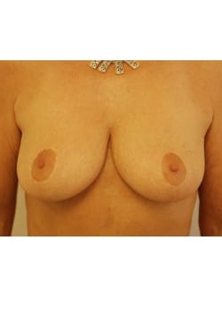 Breast Reduction Case 1