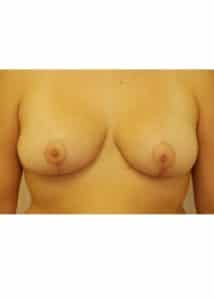 Breast Reduction Case 2
