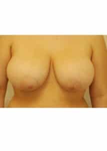 Breast Reduction Case 2