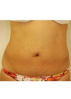 Liposuction Case 1