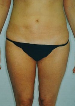 Liposuction Case 2
