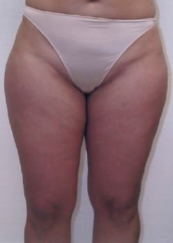 Liposuction Case 4