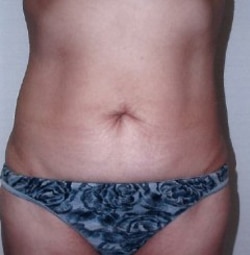 Liposuction Case 5
