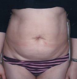 Liposuction Case 5